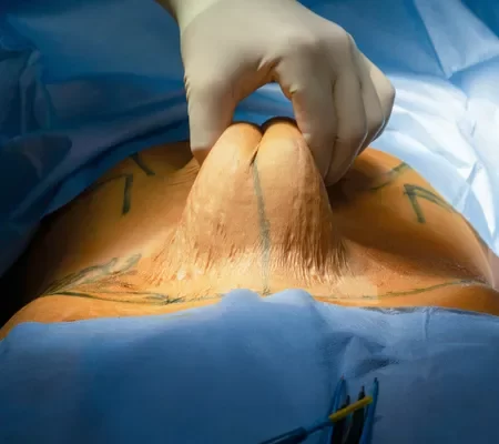 Abdominoplastia