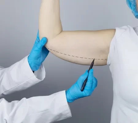 Lifting de braços (braquioplastia)