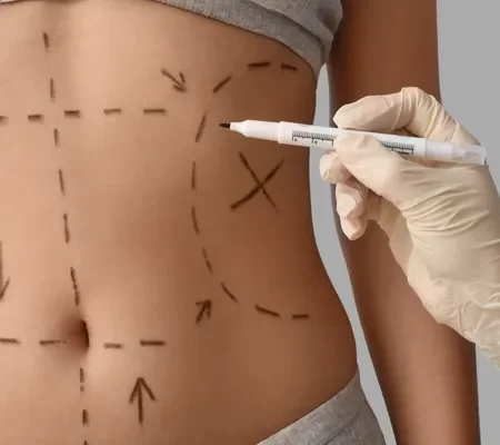 Lipo LAD (Alta Definição)