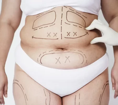 Lipoaspiração tradicional