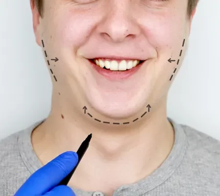 Mentoplastia (queixo)