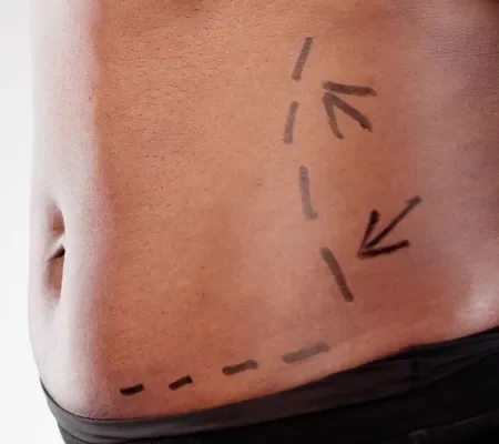 Miniabdominoplastia